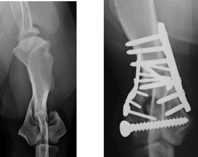 Complex humeral condylar fractures.jpg