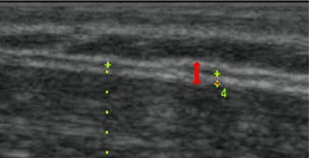 Densification - Red arrow shows separation of deep fascia.