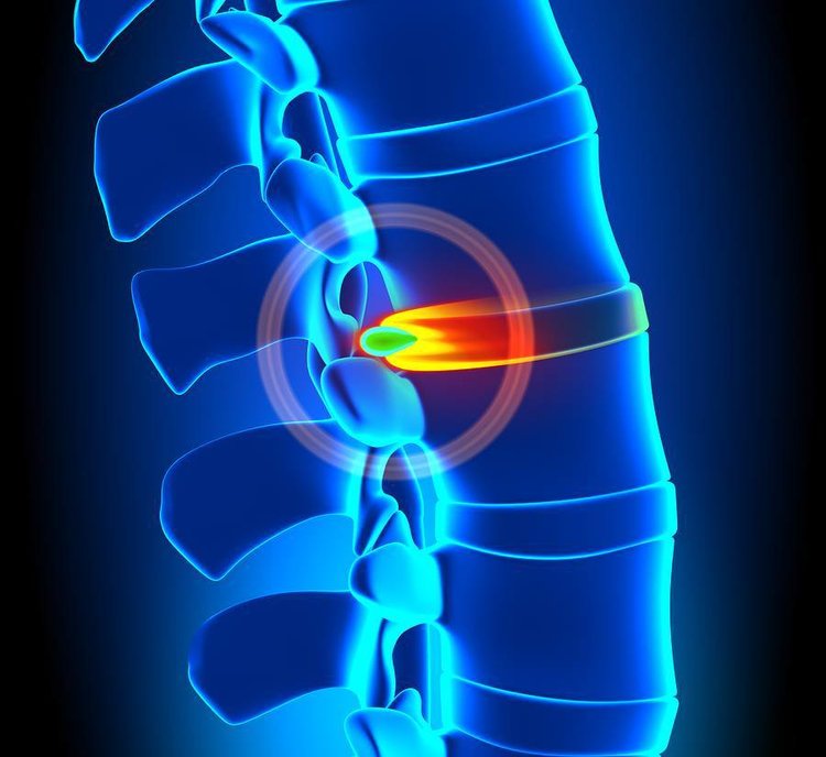 Disc+Injury.jpeg