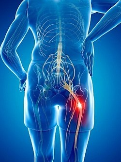 Treatment+for+Sciatica.jpeg