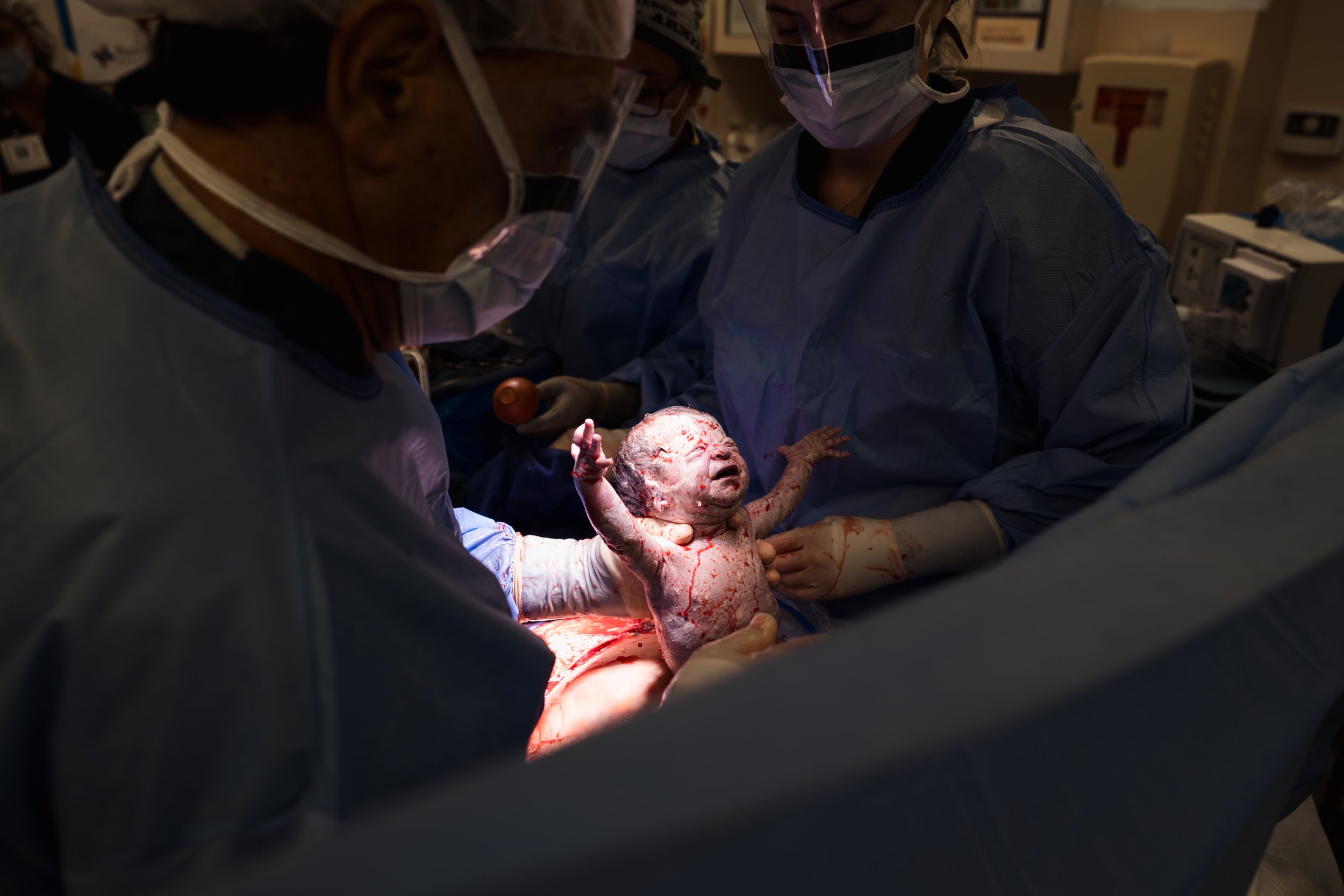 baby reaches up being born via c-section in Dallas hospital operating room