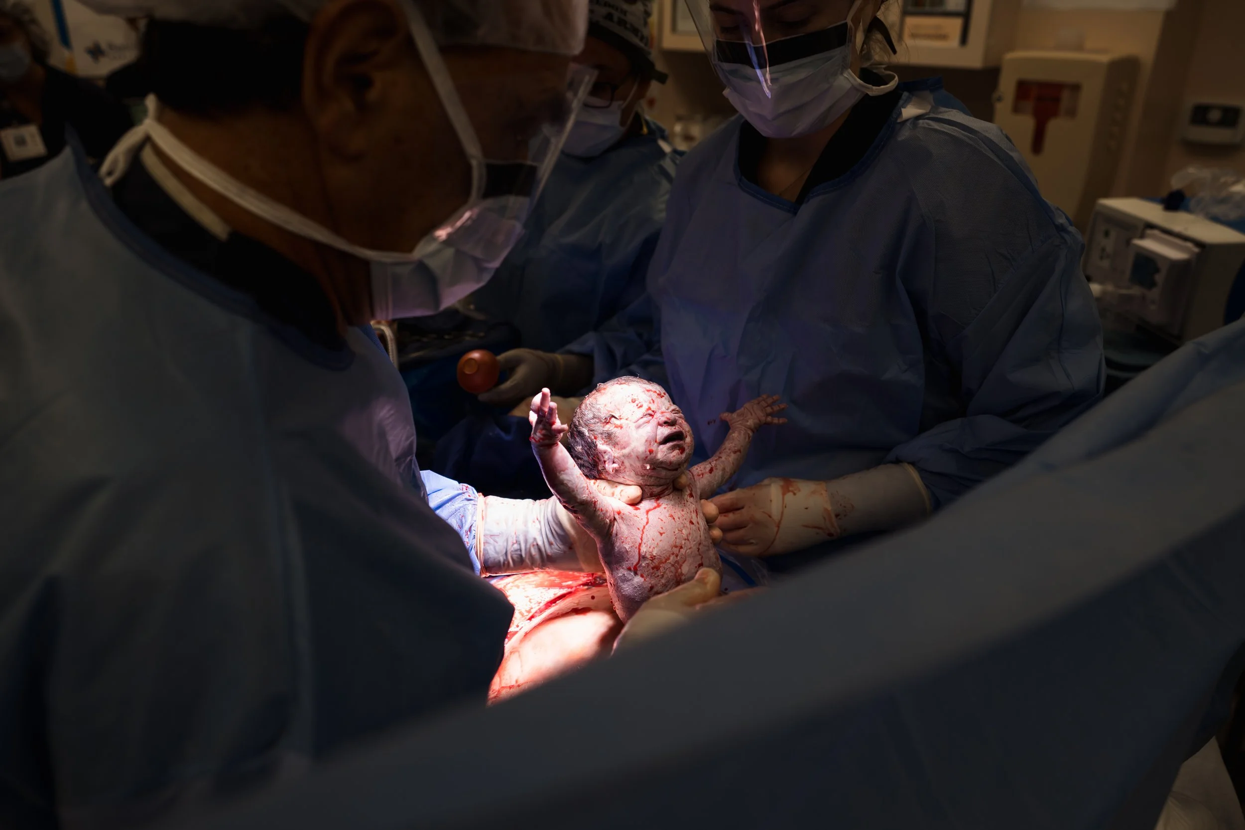 Baby Being Born C Section