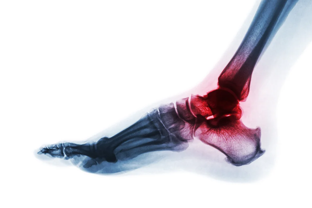 Ankle_1.jpg