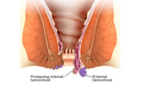 hemorrhoids-s3-illustration-of-external-hemorrhoids.jpg
