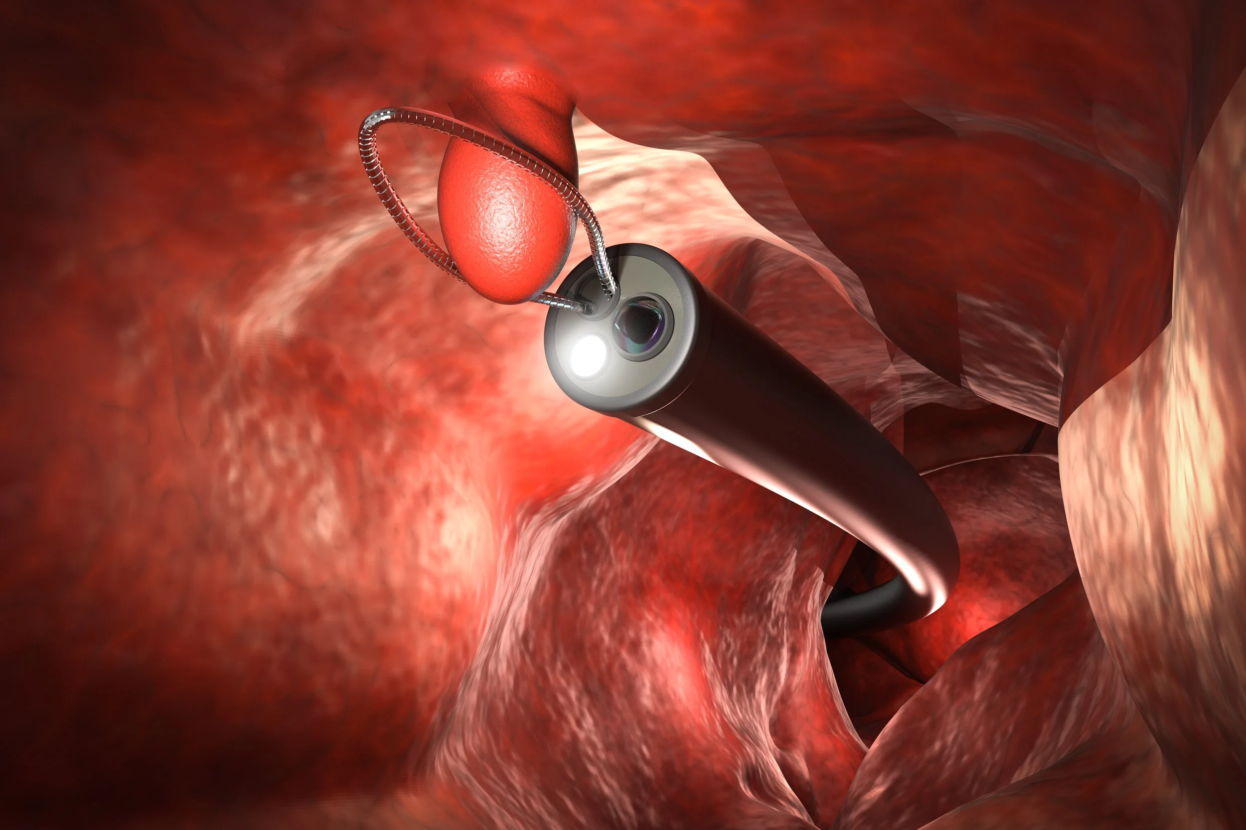 Which Rectal Cancer Surgery Is for Me? Exploring Your Options