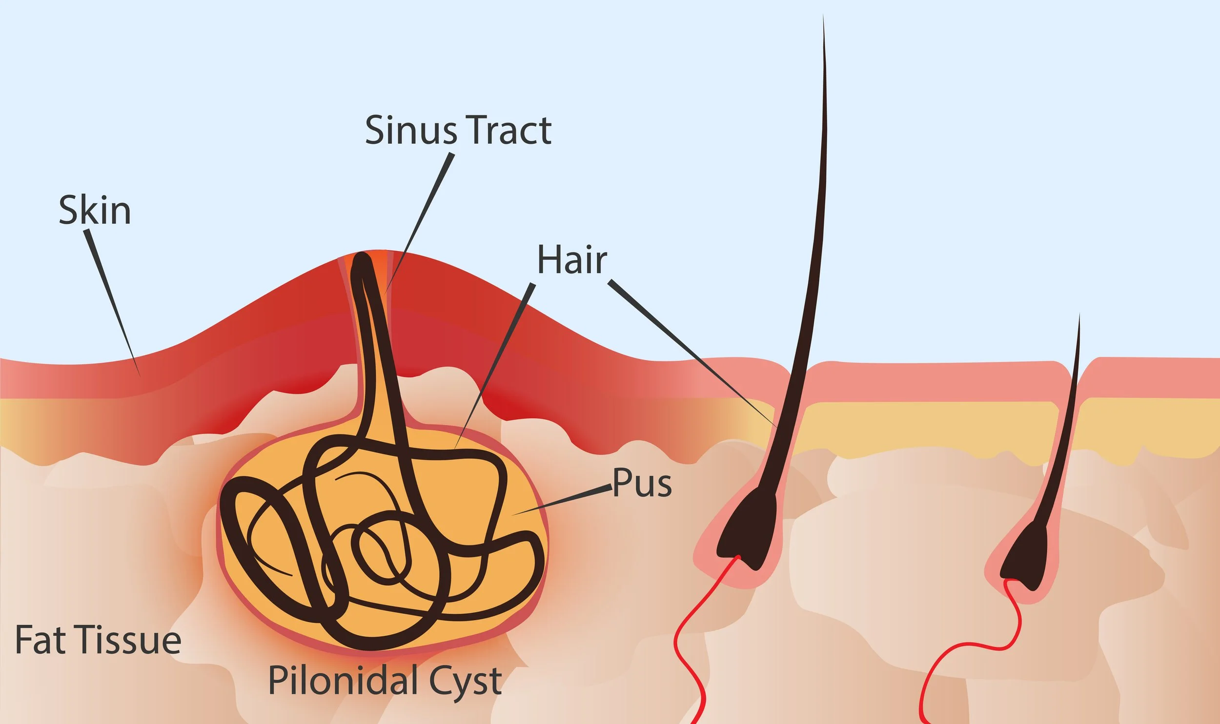 Everything You Need To Know About Pilonidal Cysts