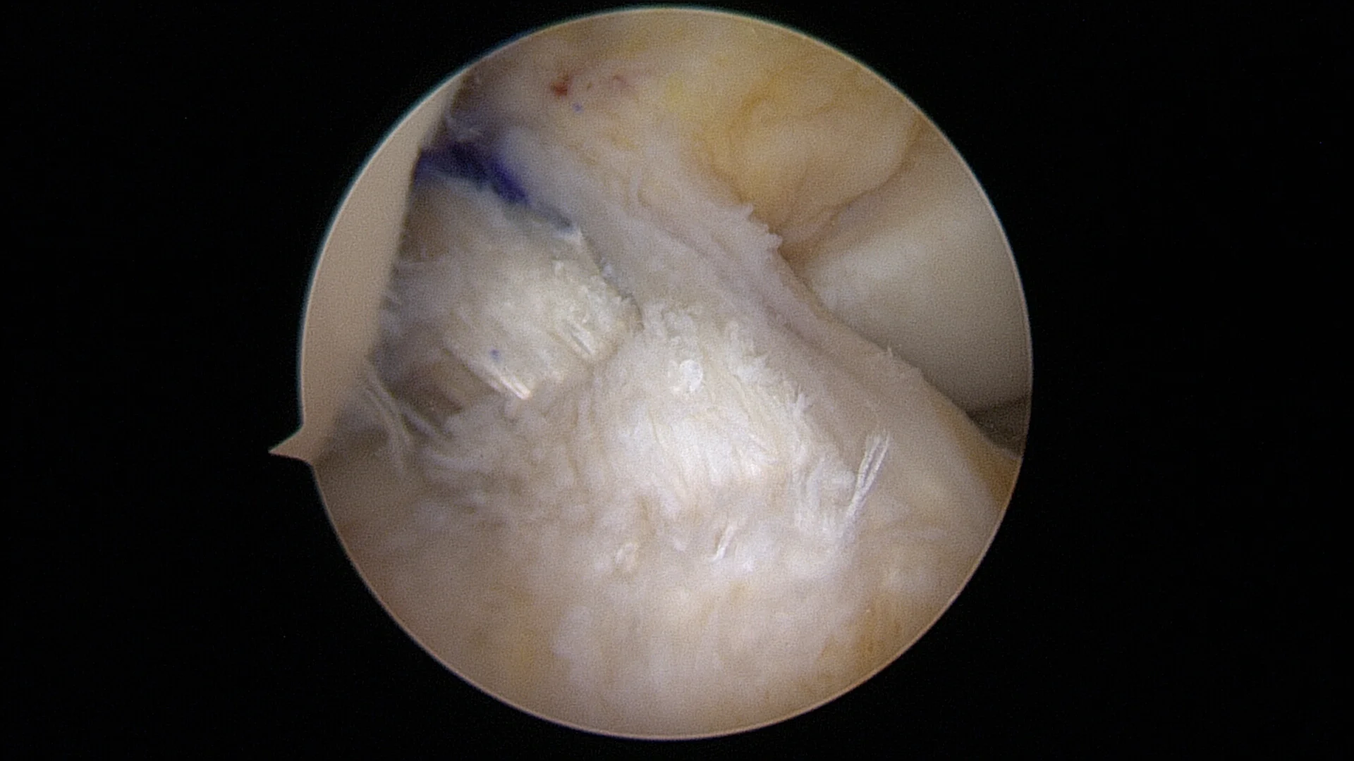 Image taken during keyhole reconstruction of a hamstring graft (blue ink) passed through the stump of the ruptured ACL