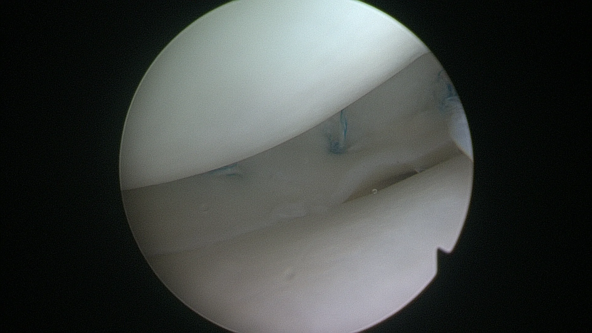 Meniscal sutures (blue) stabilising a tear