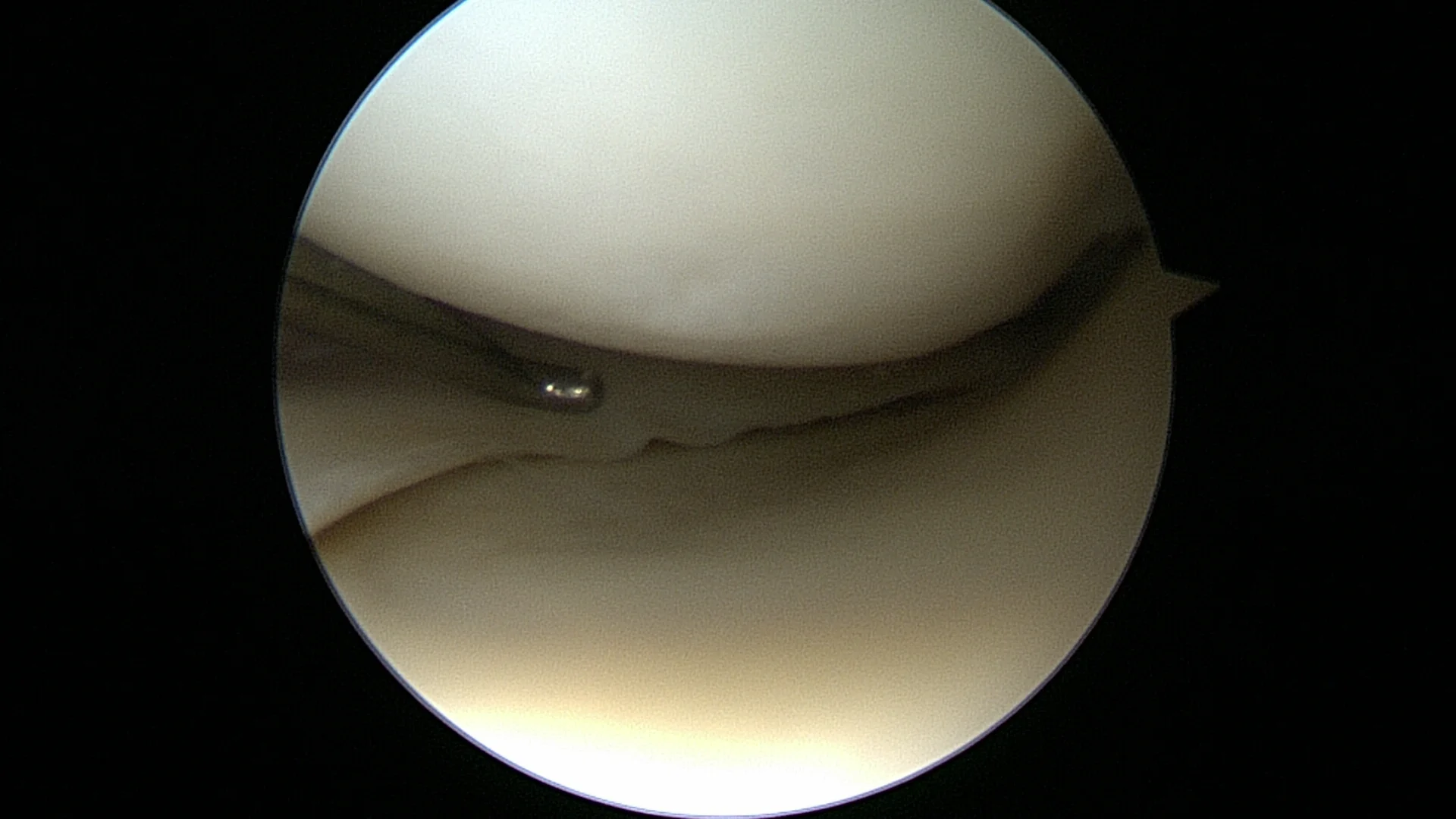 LeftKneeArthroscopy_2016-03-23-152836_Oussedik_MrSam_Still_008.jpg