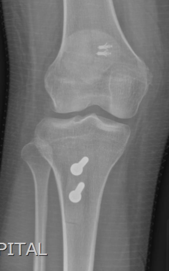 Post-operative xray showing 2 anchors in the kneecap securing the MPFL reconstruction as well as 2 screws in the shin-bone securing the shift in the the tendon realignment