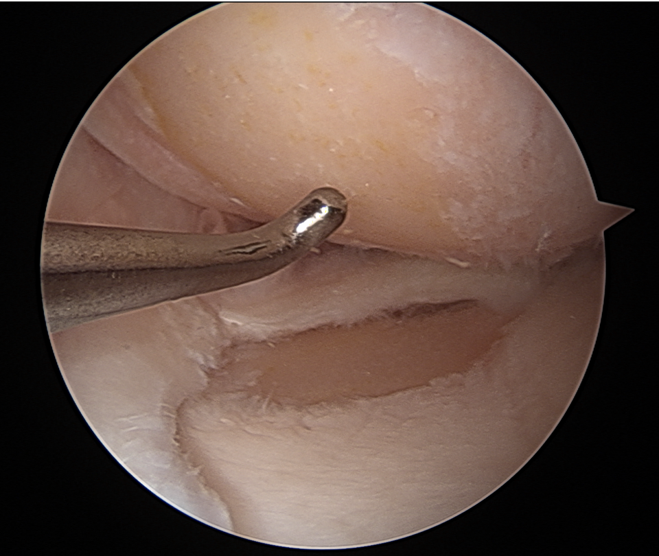 An image captured during keyhole surgery of worn out cartilage in the inner half of a knee. 