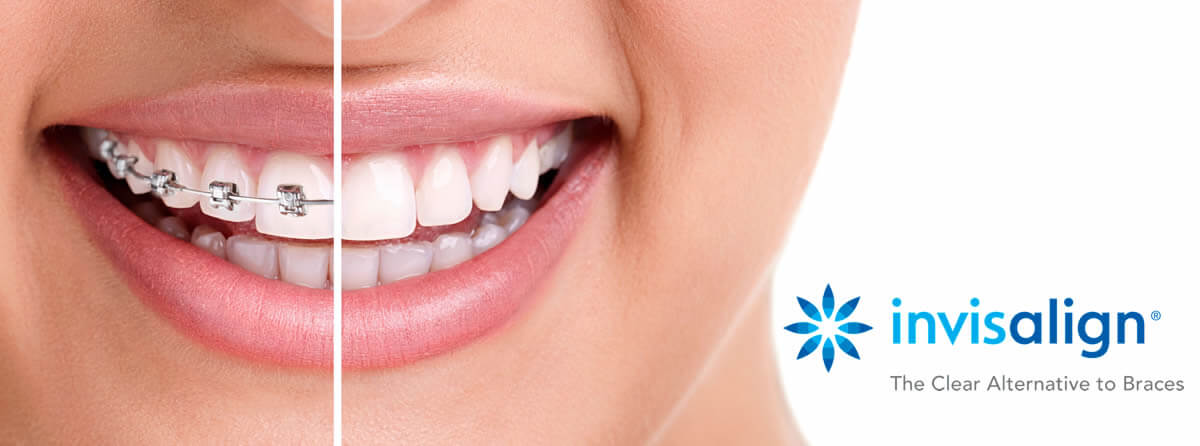 invisalign.jpg