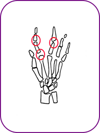 artrosis copia.png