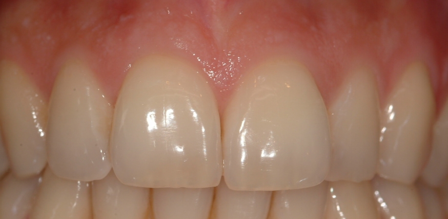Santé gingivale