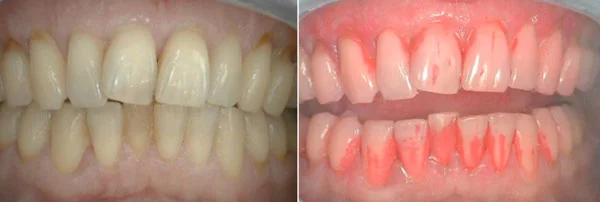 A gauche : avant application de révélateur. Les dents semblent propres A droite : après application de révélateur. La plaque est colorée en rouge 
