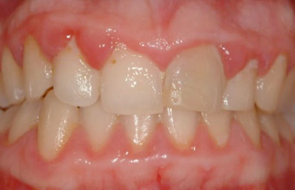 Gingivite