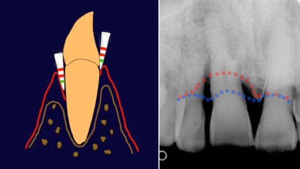 Schéma de gauche : Le sondage parodontal. A droite : situation saine, la gencive est attachée, la sonde ne passe que sur les premiers mm. A gauche : la sonde passe de plus de 3 mm dans la poche Image de droite : La radiographie. En bleu, niveau normal de l'os. En rouge, niveau de perte d'os
