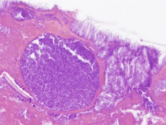 Biofilm in an infected, non-treated wound 5 days after inoculation with Staph and Pseudomonas