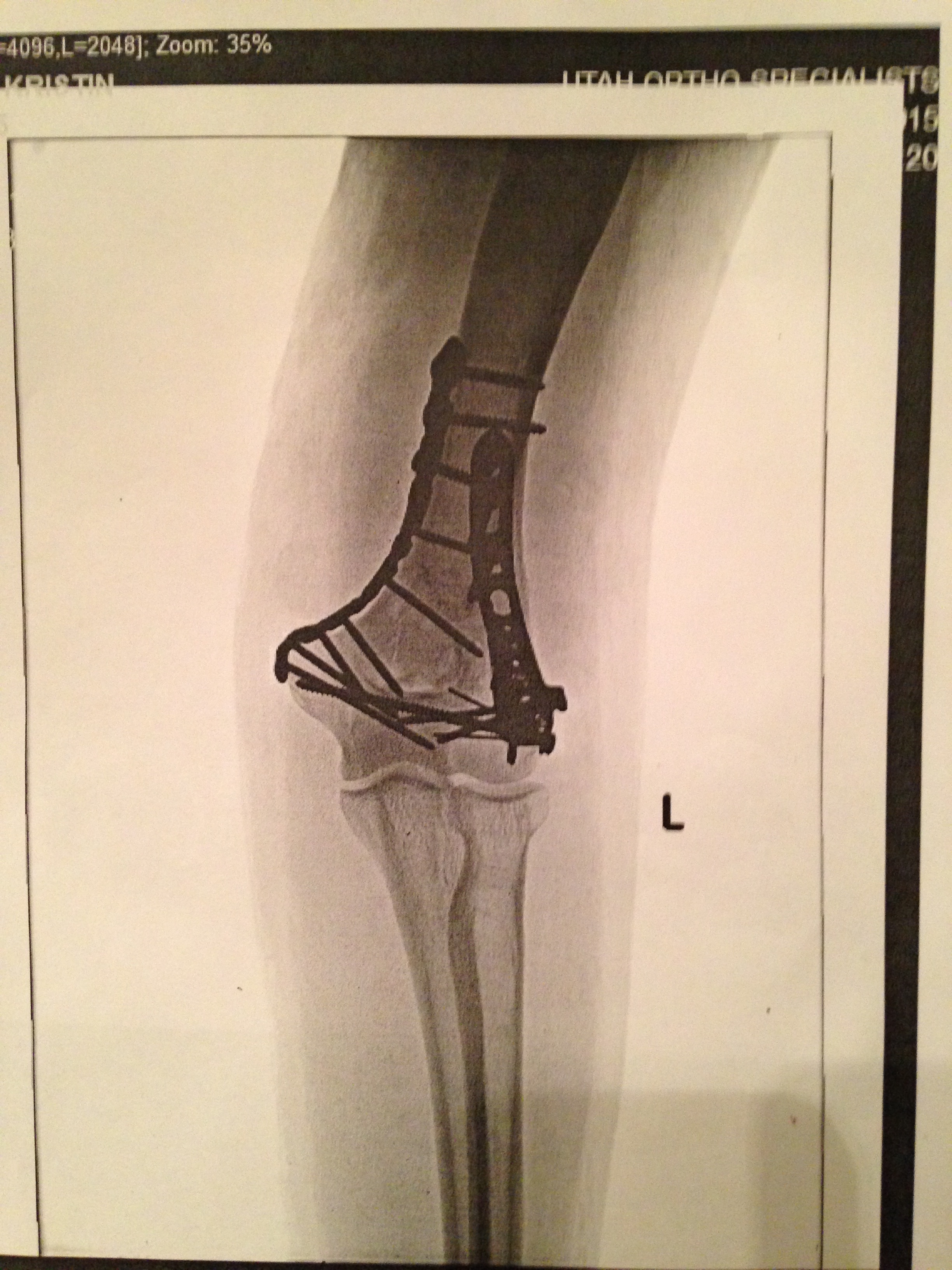 This is after the surgery. A new bionic elbow. 