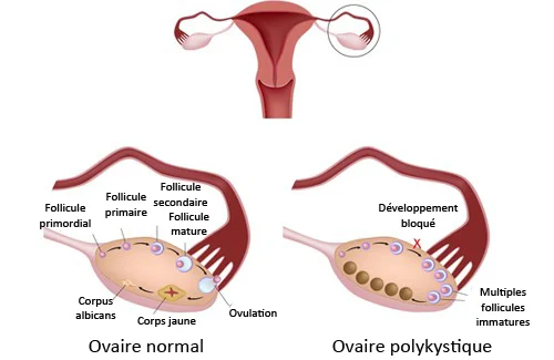 Syndrome des ovaires polykystiques et la naturopathie