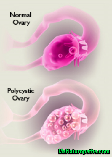 Le Syndrome des Ovaires Polykystiques (SOPK) •