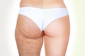 cellulite.jpeg