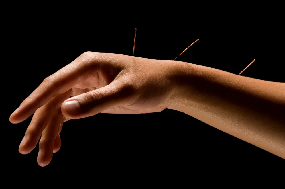 Pinpointing your body wellness - Acupuncture & Dry Needling at The Urban Physio