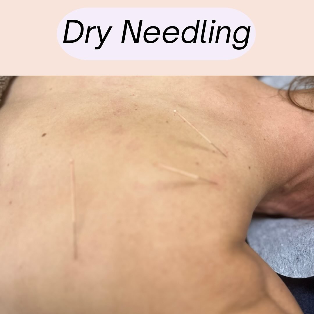 Ever wanted to try dry needling?

Here&rsquo;s a quick rundown on the process and benefits of dry needling.

All of our Myotherapists here at Myocare Plus are extensively trained in dry needling. 

If you want to give dry needling a go at your next a