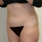 5 lbs. removed