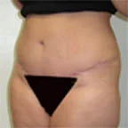 2.5 lbs. removed