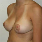 800 gms off each breast 34 C
