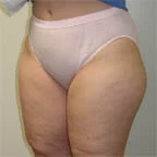Lipo of thighs 5' 1" 150 lbs.