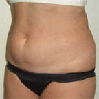 Lipo of abdomen 5' 3" 130 lbs.