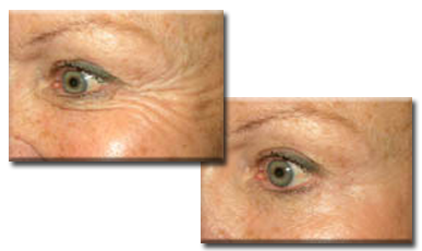 Before, and after Botox injections to crows feet.