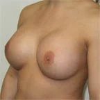 Post-op 650 cc 36 D