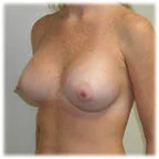 Post-op 350 cc 34 C