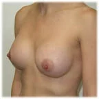 Post-op 300 cc, 34B