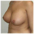 Post-op 450 cc 36 D