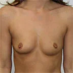 Right breast is higher on chest wall