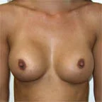 Assymetry remains after surgery due to uneven rib cage