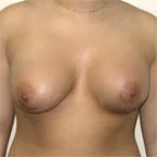 Two different size implants are placed.