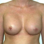 ...will give a narrow cleavage after surgery