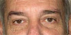 Brow, upper & lower lids