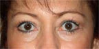 Brow, upper & lower lids