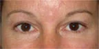 Brow plus upper lids.