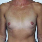 A rounded rib cage with nipples pointing outwards...