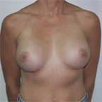 ...will make the implants point outwards.