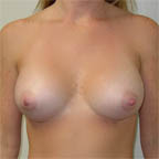 ...resulting in implants pointing more forward