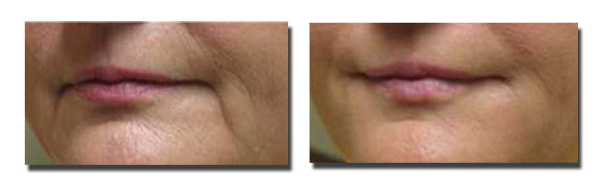 Before Fillers to Marionette Lines, and Six Weeks After Fillers (2cc Juvederm)