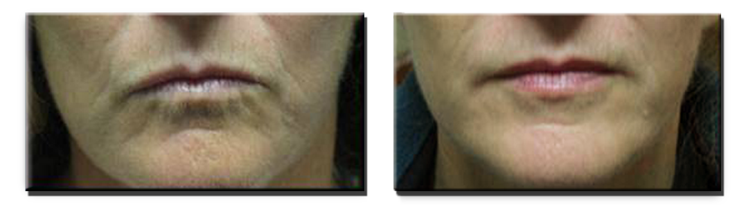 Before Fillers Around the Mouth, and Five Months After Fillers (2cc Juvederm)